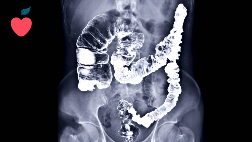divertículos y diverticulosis